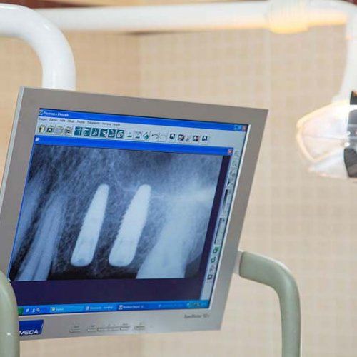 Implantes dentales en Olesa