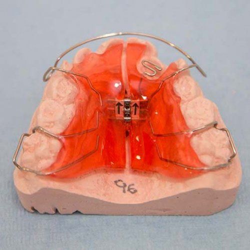 Tratamiento de ortodoncia convencional o invisible en Olesa de Montserrat
La ortodoncia es la especialidad que se encarga del diagnóstico, prevención y tratamiento de la mala posición dental.
Podemos destacar tres tipos de ortodoncia:
Aparatología fija a los dientes (Brackets) Ortodoncia invisible (invisalign) Ortopedia dentofacial
 