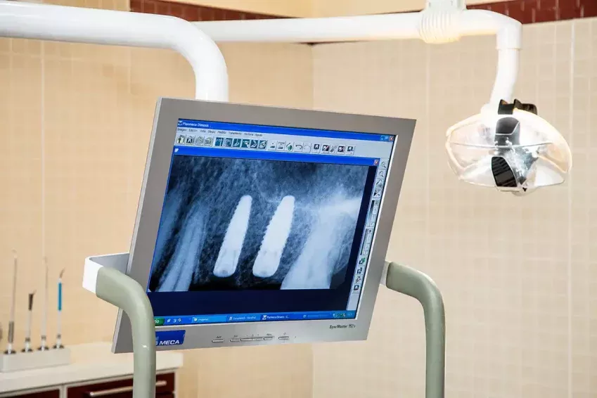 Implants dentals