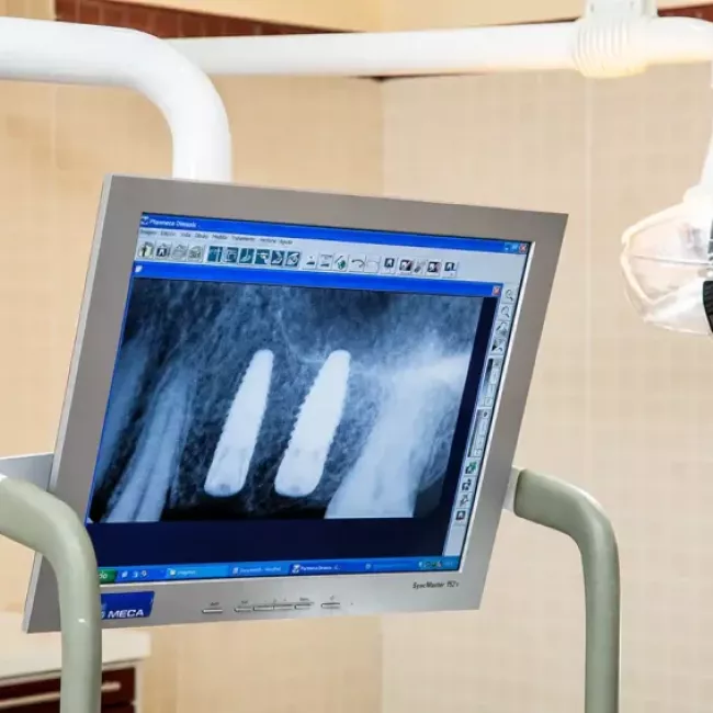 Implants dentals